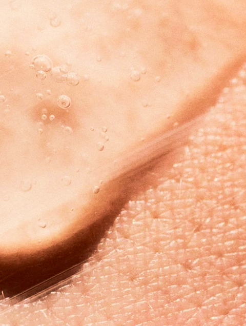 AHA Exfoliation for Hyperpigmentation: How to Use Acids Safely on Sensitive Skin