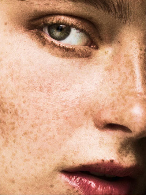 What Causes Hyperpigmentation (and How to Fade It Without Irritating Sensitive Skin)